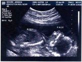 2000-06-23-first-ultrasound-profile02.jpg