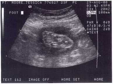 Baby foot
