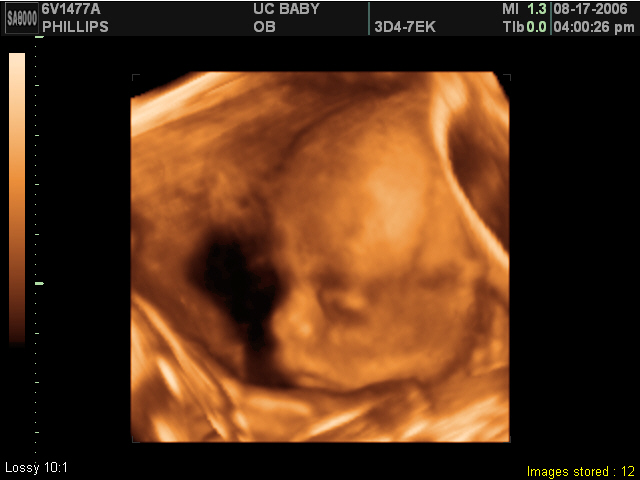 2006-08-17-3d-ultrasound-11.JPG
