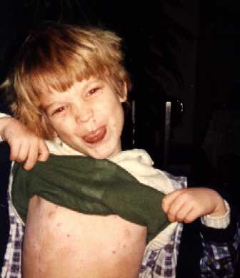 Chicken pox
