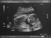 Filename=2004-12-03-ultrasound01.jpg
Filesize=228KiB
Dimensions=1095x831
Date added=Sep 05, 2005 2004-12-03-ultrasound01.jpg