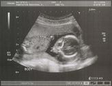 Filename=2004-12-03-ultrasound03.jpg
Filesize=235KiB
Dimensions=1091x829
Date added=Sep 05, 2005 2004-12-03-ultrasound03.jpg