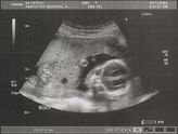 Filename=2004-12-03-ultrasound04.jpg
Filesize=226KiB
Dimensions=1085x823
Date added=Sep 05, 2005 2004-12-03-ultrasound04.jpg